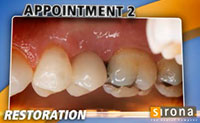 3D Implants Guided Implant Placement 10