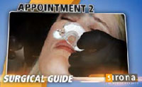 3D Implants Guided Implant Placement 9
