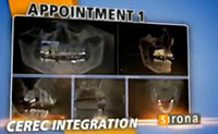 3D Implants Guided Implant Placement 7
